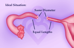 Is Reversal Right for me? | FertilityAnswers