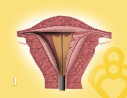 Endometrial Ablation - New Treatments for Heavy Periods Fertility Answers