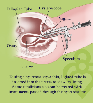 hysteroscopie